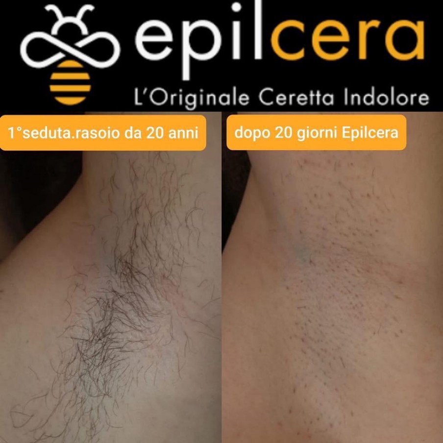 Trattamento Epilcera l'originale ceretta indolore