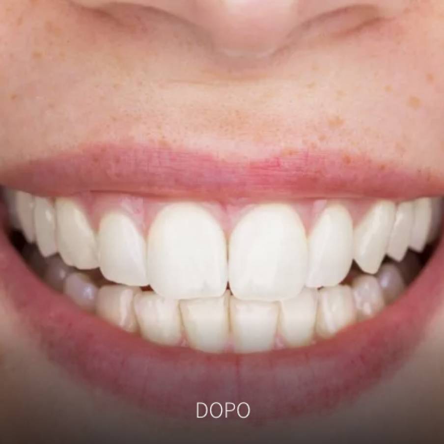 SBIANCAMENTO (BLEACHING)