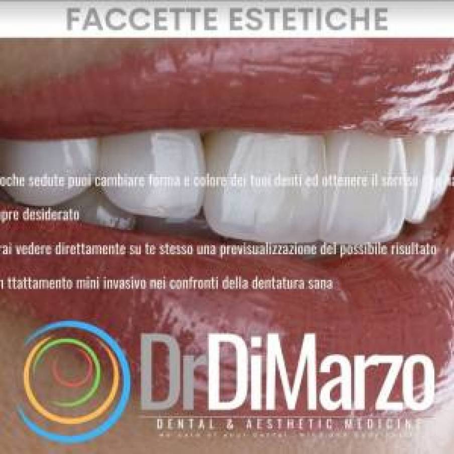 Faccette estetiche