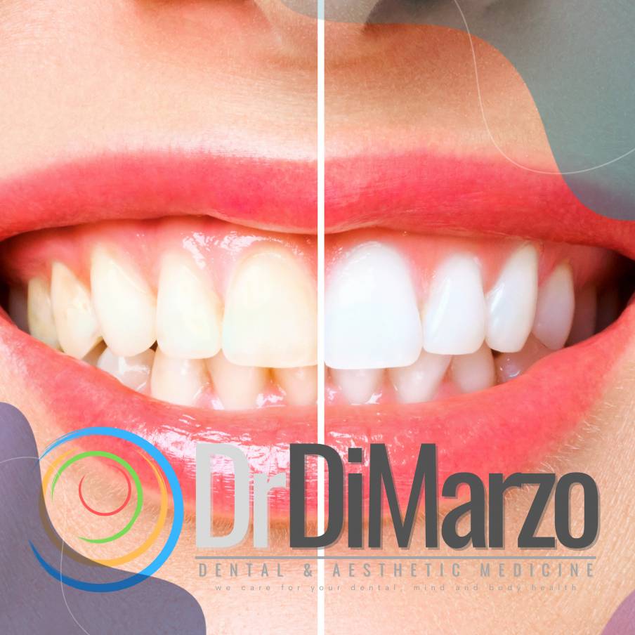 Sbiancamento professionale